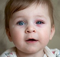Everything to Know About Pink Eye